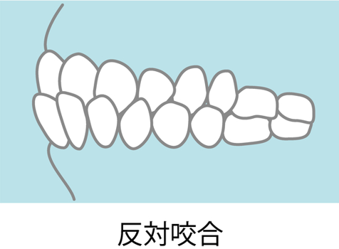 反対咬合のイメージ画像