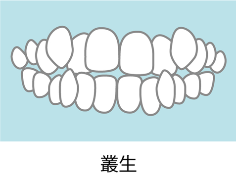 乱杭歯・八重歯（叢生）のイメージ画像