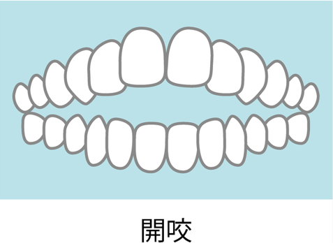 開絞のイメージ画像