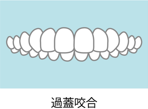 噛み合わせが深い（過蓋咬合）のイメージ画像
