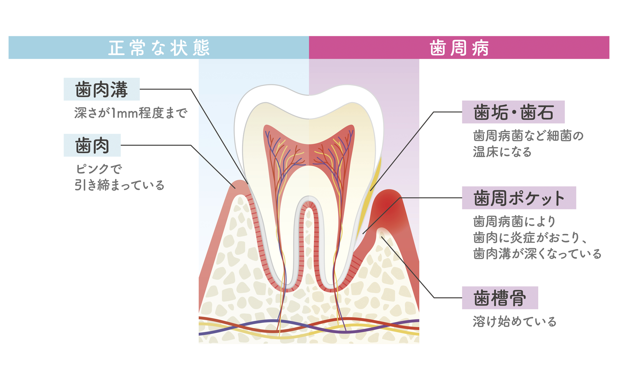 こんな症状は歯周病のサインです