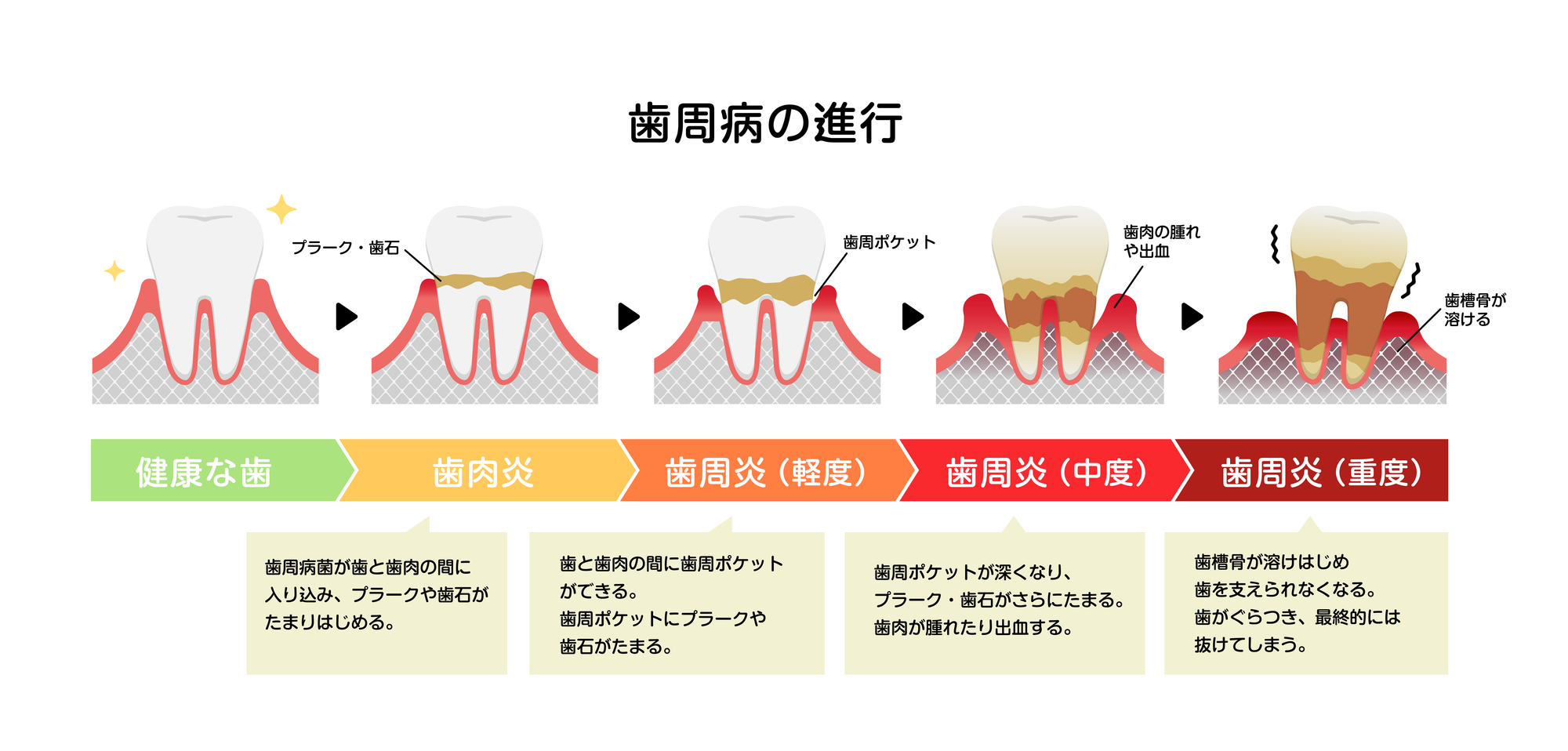 歯周病の進行段階