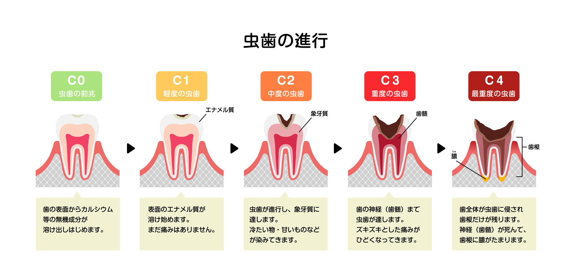 虫歯の進行度のイメージ画像│瀬戸市での虫歯治療なら瀬戸歯科