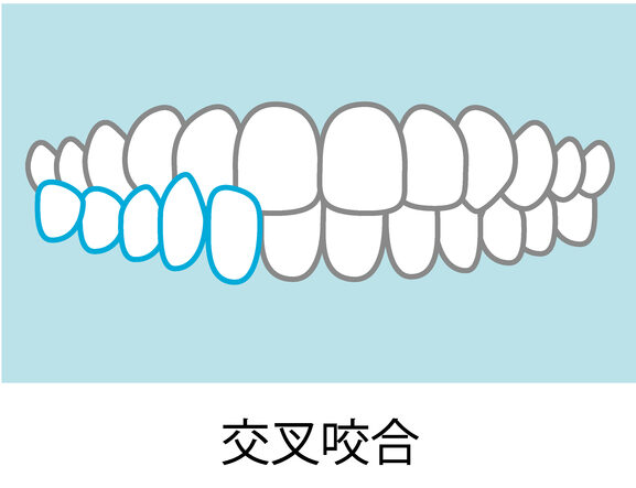 上下の噛み合わせが反対になっている（交叉咬合）のイメージ画像