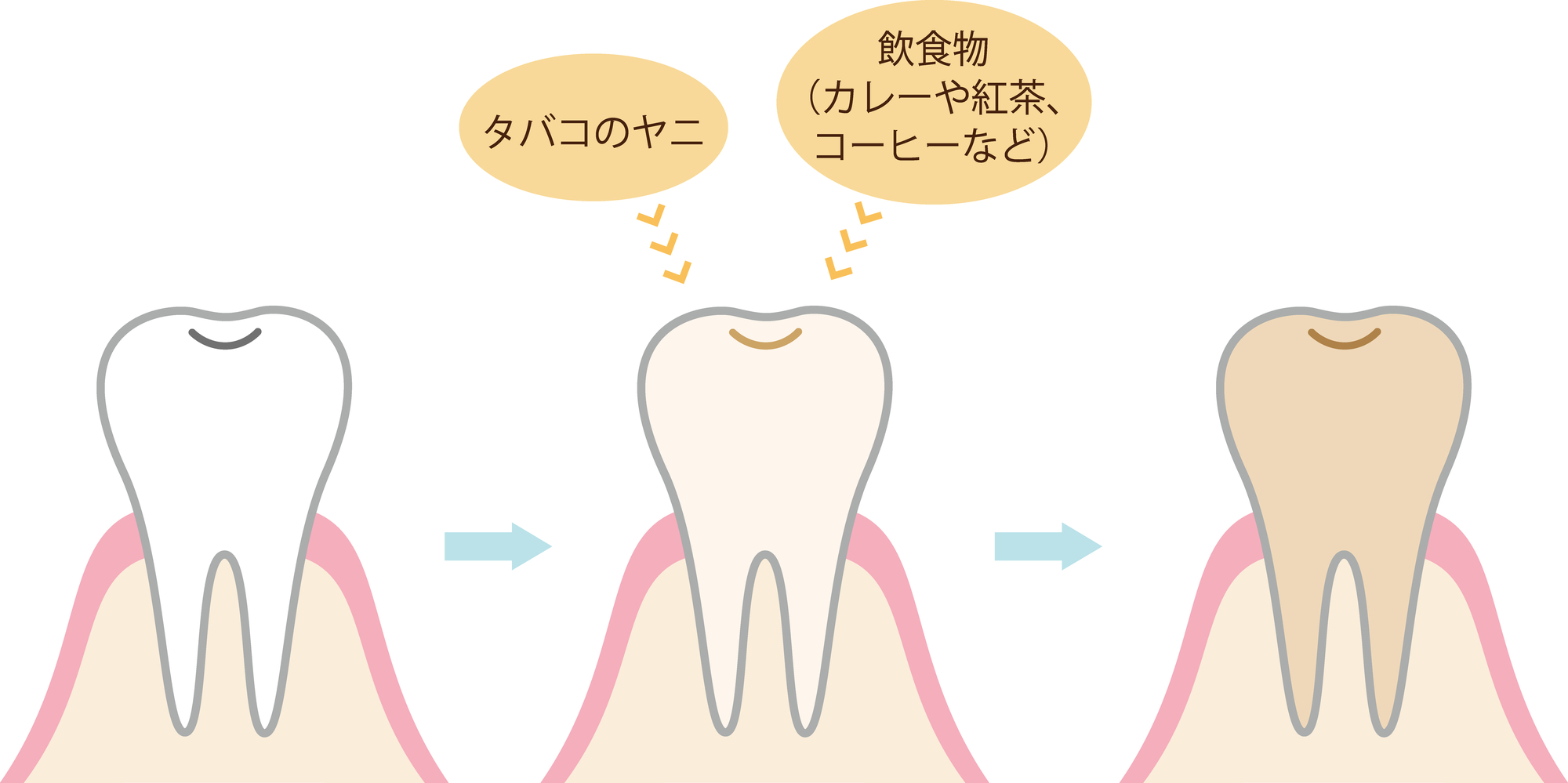 歯の着色汚れのイメージ│瀬戸市でホワイトニングを行う瀬戸歯科